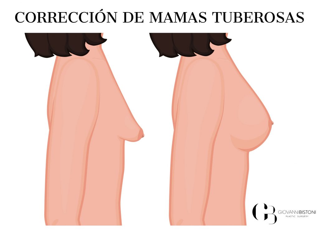 Corrección de mamas tuberosas