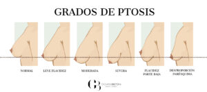 grados de ptosis mamaria mastopexia elevación de senos en Valencia