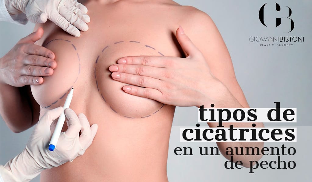 Tipo de cicatriz después de una aumento de pecho