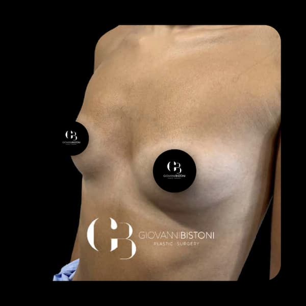 Ejemplo de cirugía plástica mamaria, mastopexia con aumento. Caso 2. Antes de la operación.