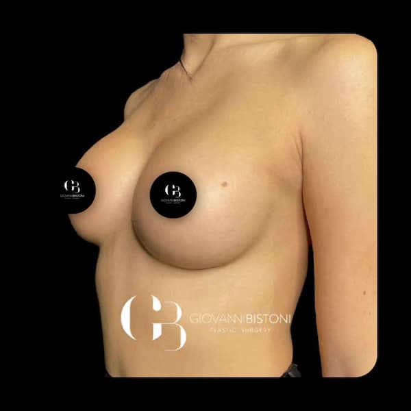 Ejemplo de cirugía plástica mamaria, mastopexia con aumento. Caso 1. Después de la operación.
