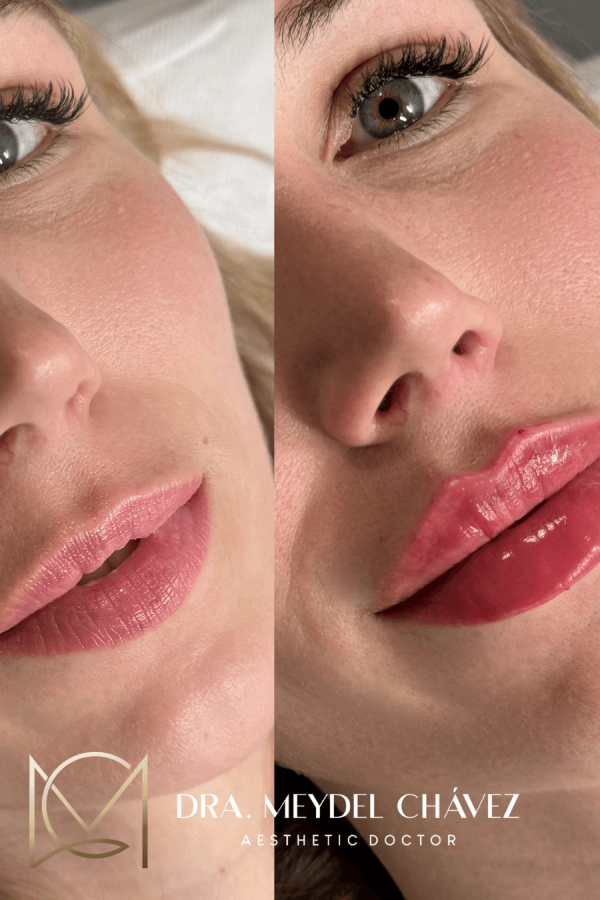 meydel-chavez-medicina-estetica-antesydespues-1.png