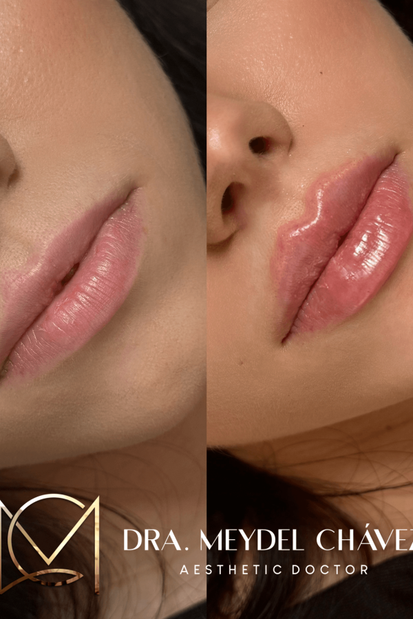 meydel-chavez-medicina-estetica-antesydespues-2.png