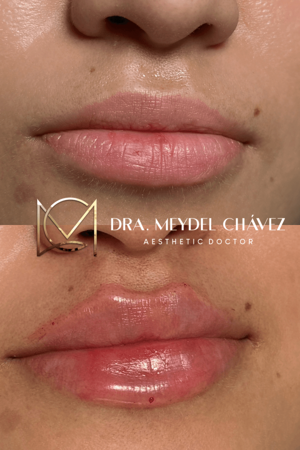 meydel-chavez-medicina-estetica-antesydespues-3.png