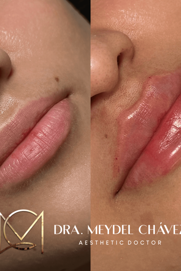 meydel-chavez-medicina-estetica-antesydespues-4.png